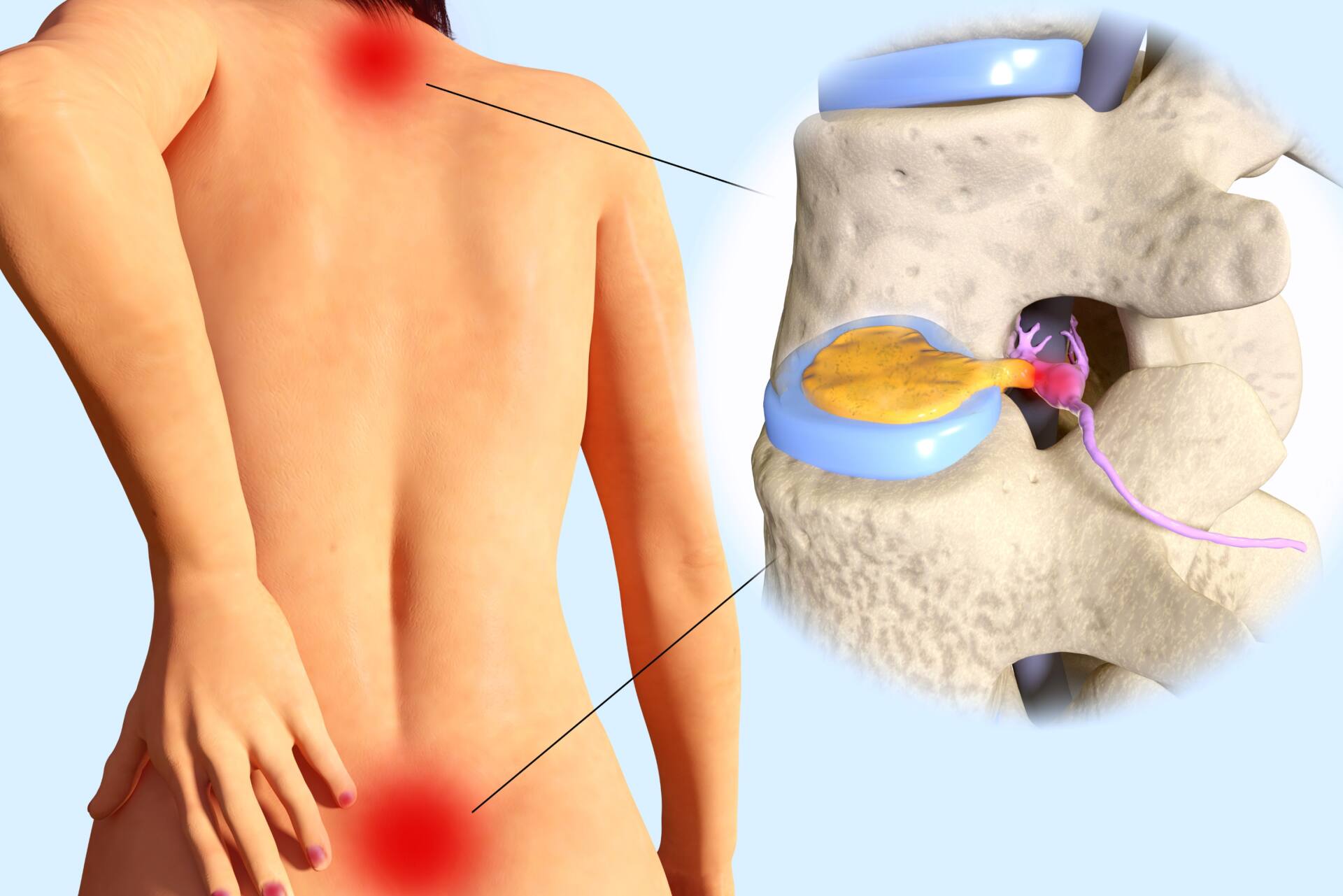 カイロプラクティック　症状　椎間板ヘルニア